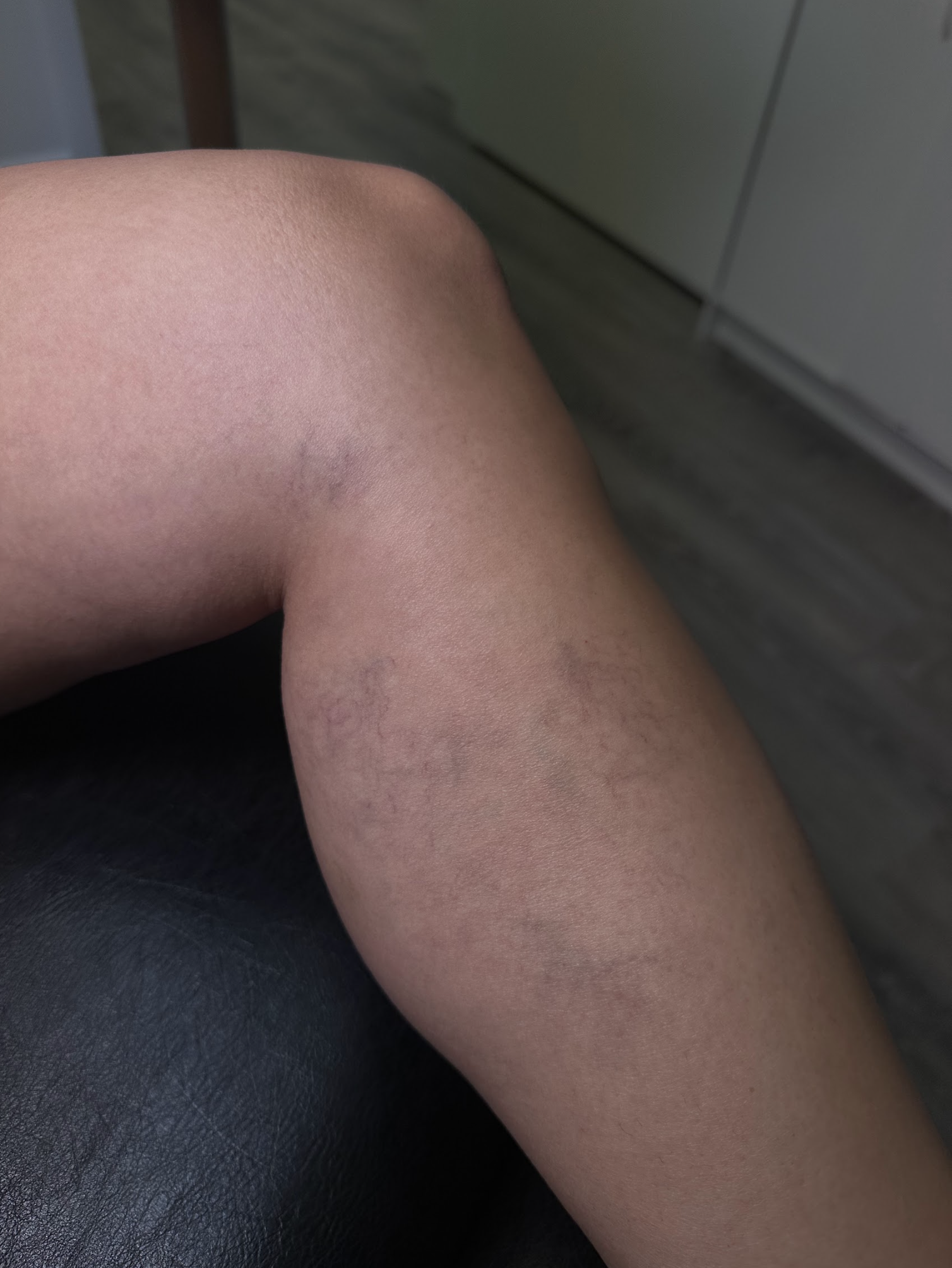 Sclerotherapy Boca Raton FL